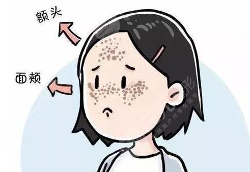 激光去黃褐斑