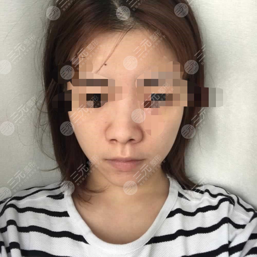 隆鼻前后對比果圖片