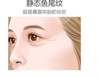 除魚尾紋針能管多久