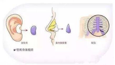 隆鼻手術的分類