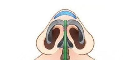 人工骨隆鼻