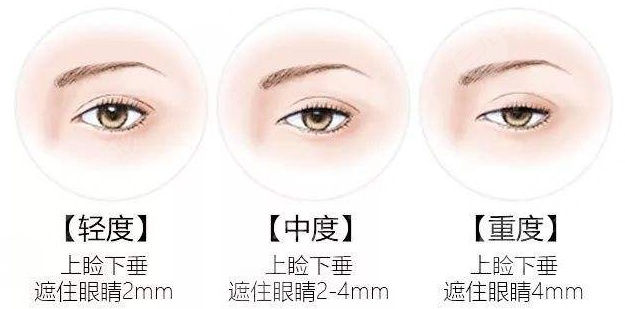眼皮松弛怎么辦？愛美者一定要引起足夠的重視！