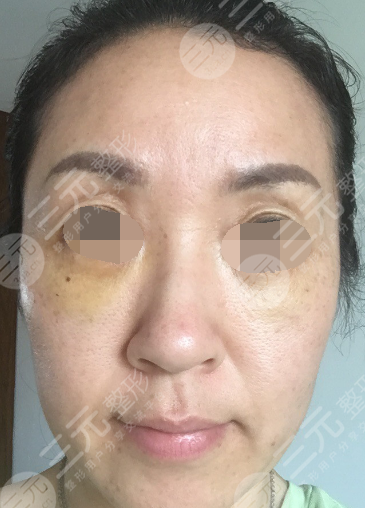 面部年輕化plus全臉，快速解決面部問題，內(nèi)附真實(shí)案例分享圖