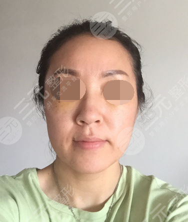 面部年輕化plus全臉，快速解決面部問題，內(nèi)附真實(shí)案例分享圖