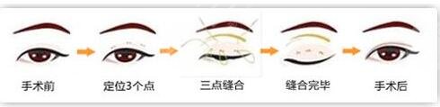 韓式微創(chuàng)雙眼皮維持時間
