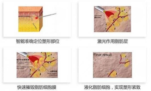 激光溶脂的副作用有哪些