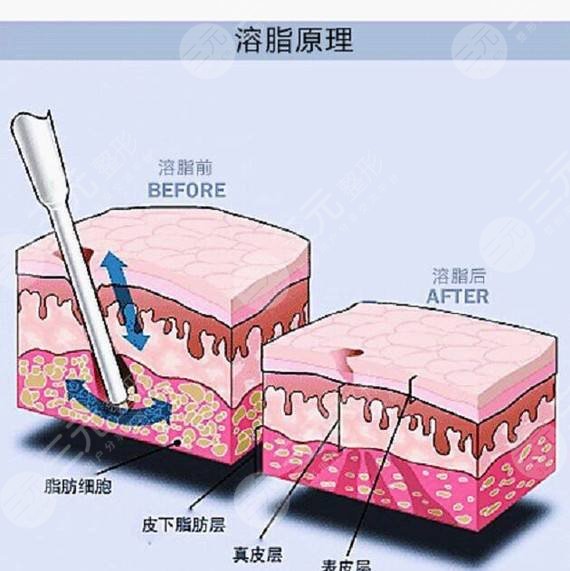 激光溶脂怎么樣
