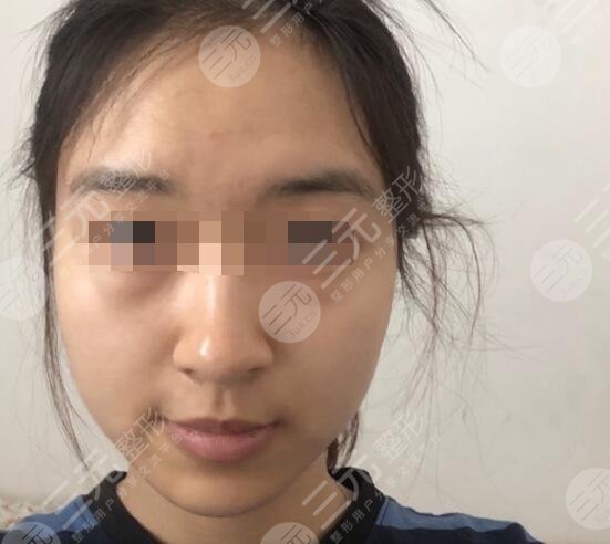 光子嫩膚價格
