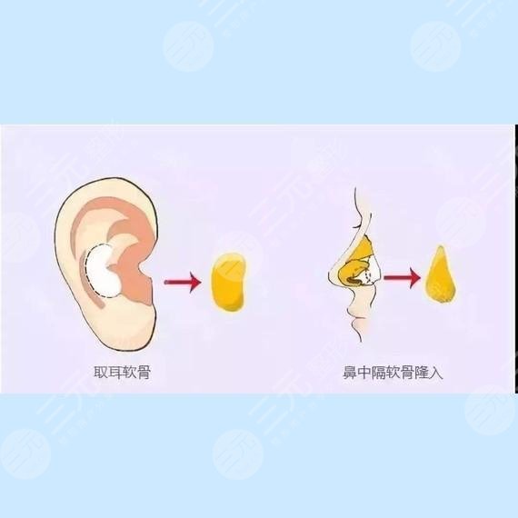 自體軟骨隆鼻