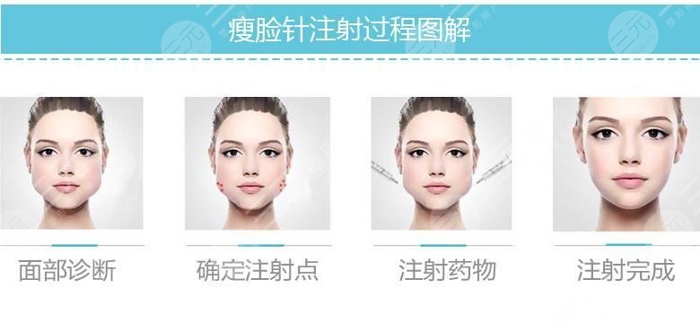 咬肌瘦臉種類