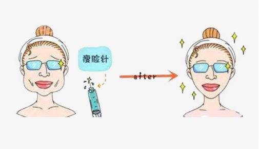 咬肌瘦臉種類