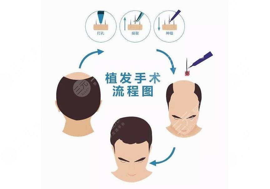 什么是植發(fā)