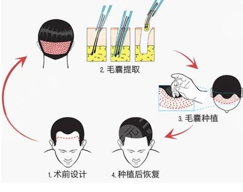 植發(fā)后會(huì)脫落嗎?植發(fā)能夠維持多久呢?