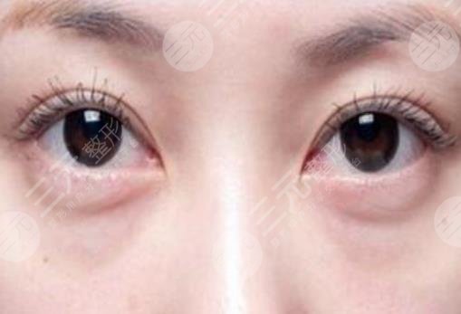 溫水敷眼