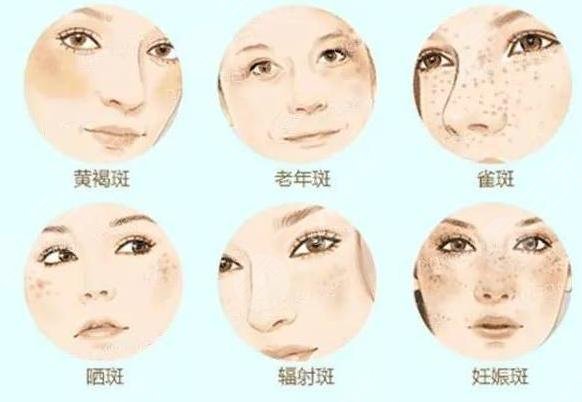 彩光緩解黃褐斑原理是怎樣的？彩光緩解黃褐斑注意事項(xiàng)須知！