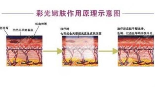彩光緩解黃褐斑原理是怎樣的