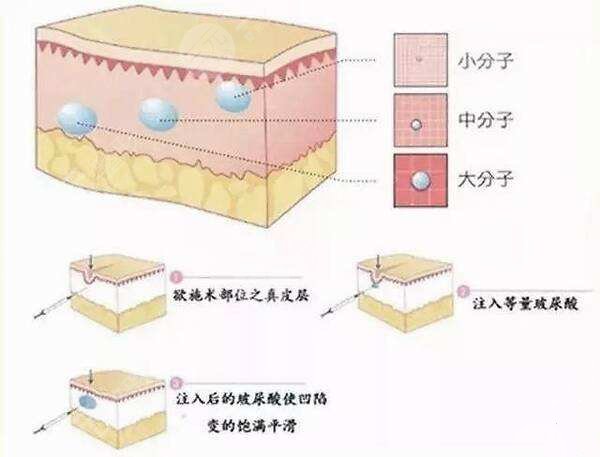 顱耳角在30°-60°之間注射材料