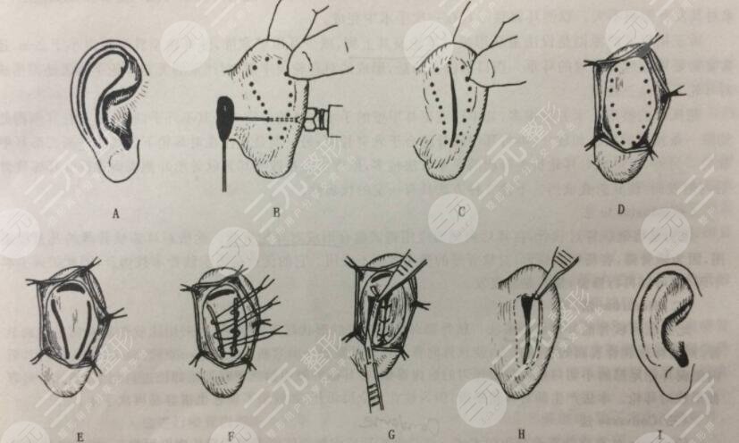 顱耳角在30°-60°之間是一種天生畸形，矯正方法如下