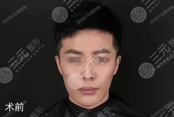 網紅圈都在做的顱耳角在30°-60°之間整形前