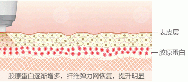 量子微雕美容
