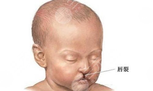 唇腭裂能完全修復好看不到痕跡嗎？唇腭裂恢復正常有多難？