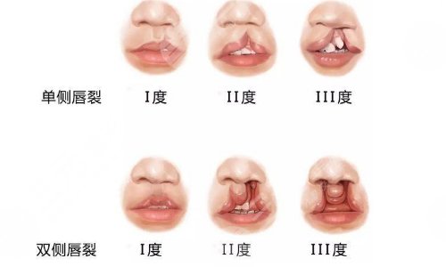 唇腭裂可以完全修復嗎