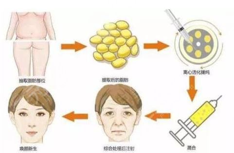 脂肪填充多久能恢復(fù)？填充臉部需要多少錢？附價(jià)格表+相關(guān)介紹