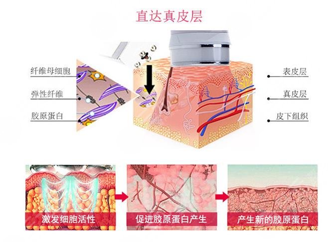 光子嫩膚祛痘印