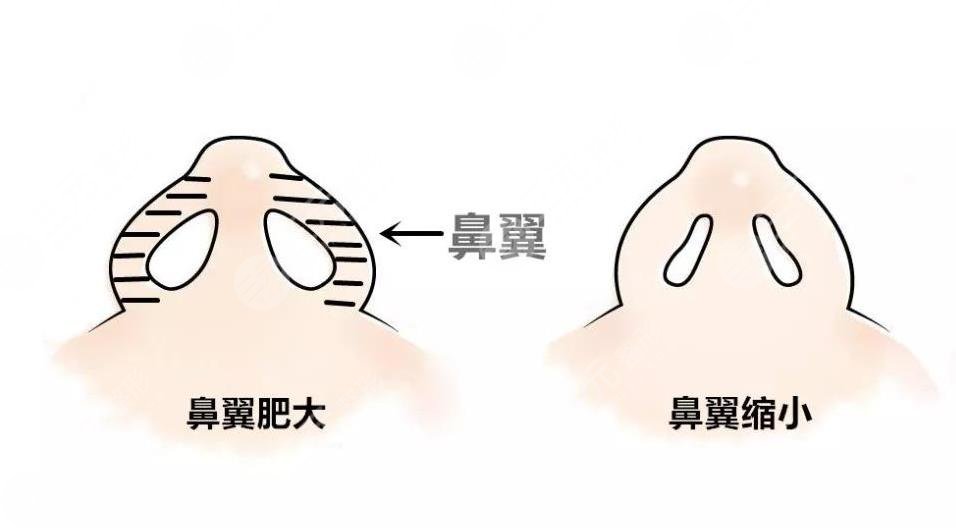 鼻翼太寬怎么整形？鼻翼縮小手術(shù)怎么樣？附鼻部整形價(jià)格表