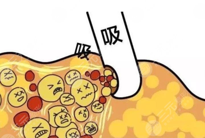 瘦身欄目|超脂塑吸脂有沒有副作用？來看看哪些人不適合做！
