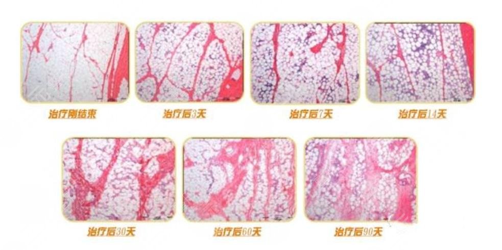 超脂塑是什么?