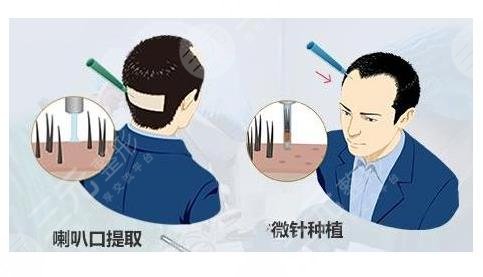 植發(fā)相關(guān)問答科普介紹