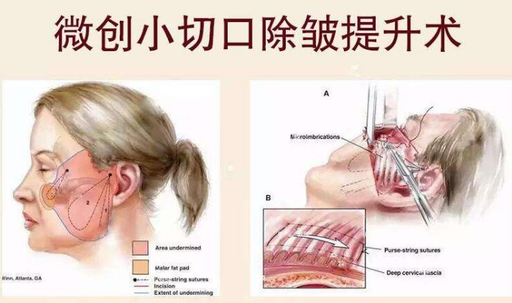 北京加減美拉皮手術(shù)專家科普知識(shí)