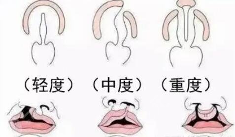 兔唇矯正
