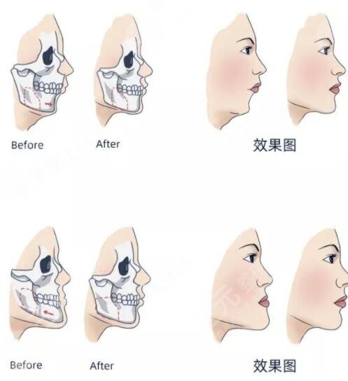 正頜手術(shù)
