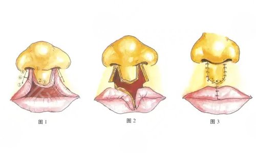 做疤痕修復手術(shù)之前需要注意什么