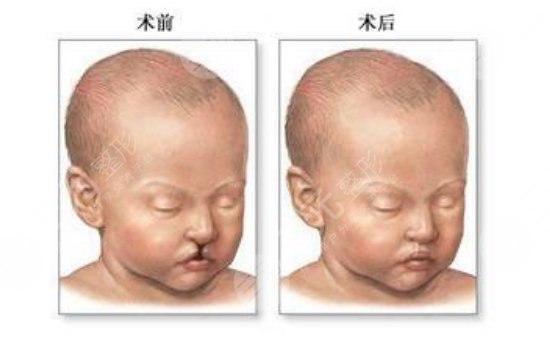 做疤痕修復手術(shù)注意事項