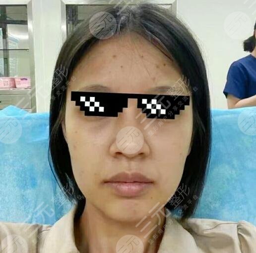 7d聚拉提體驗(yàn)果圖