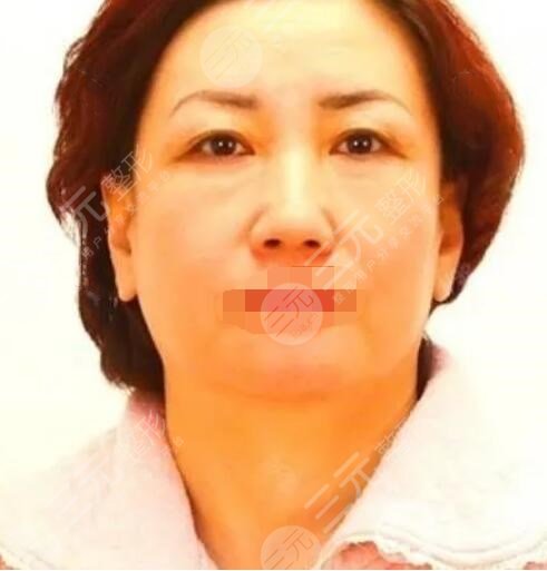 真人中面部抗衰術前