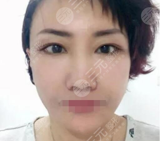 真人中面部抗衰術后一周