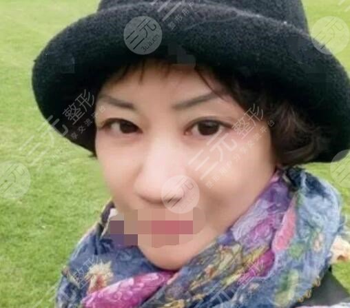 真人中面部抗衰術后3周