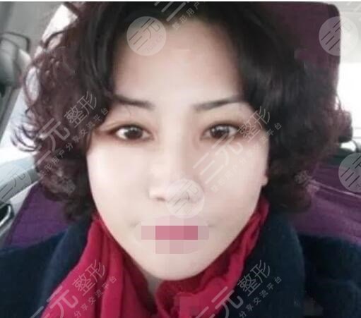 真人中面部抗衰術后5周