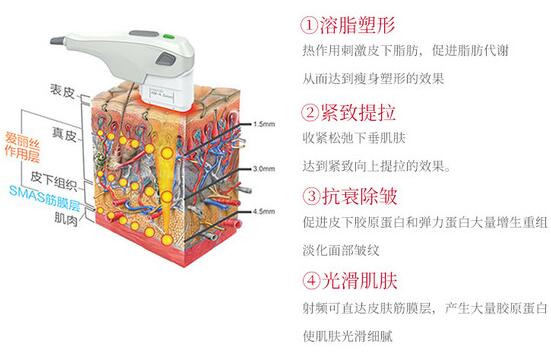 btl射頻溶脂