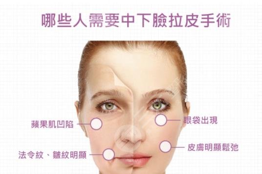 科普|中面部拉皮手術(shù)切口在哪兒？費(fèi)用是多少？一個(gè)月消腫是真的嗎？