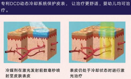 胎記怎么去除
