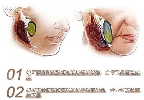 內(nèi)窺鏡除皺術(shù)缺點科普！手術(shù)果到底咋樣？一文解答你的困惑，附價格~