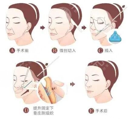拉皮除皺手術有什么優(yōu)點