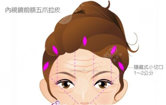 內(nèi)窺鏡拉皮手術(shù)果保持幾年？維持時(shí)間解析+手術(shù)注意事項(xiàng)解答