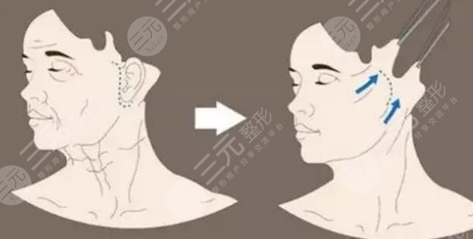內(nèi)窺鏡拉皮手術(shù)是什么原理
