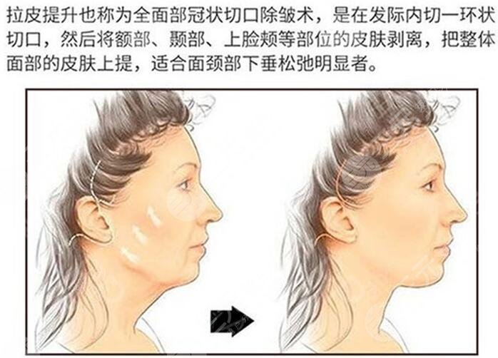 內窺鏡除皺術
